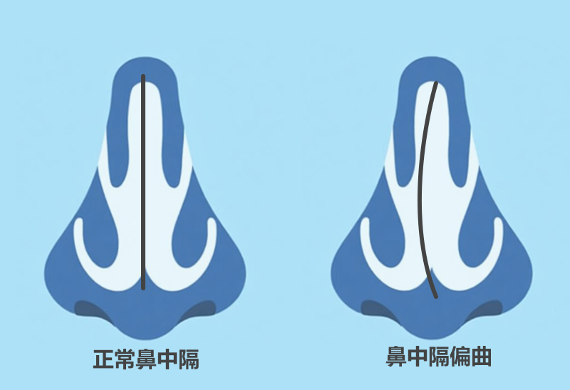 鼻塞反复难缓解？鼻中隔偏曲别忽视 