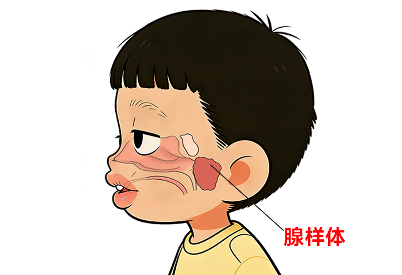 一．什么是腺样体肥大