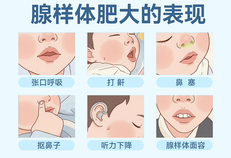 小心，别让腺样体肥大成为孩子的“颜值杀手”